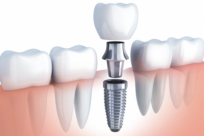 Implants Dentist in Canton